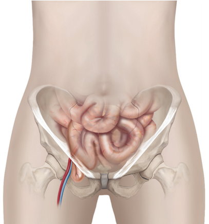 Jersey Colorectal Group - Femoral Hernia Repair